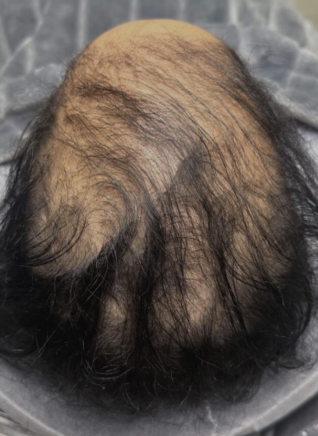 Scalp micropigmentation results McAllen TX — hair tattoo before and after RGV Scalp Ink